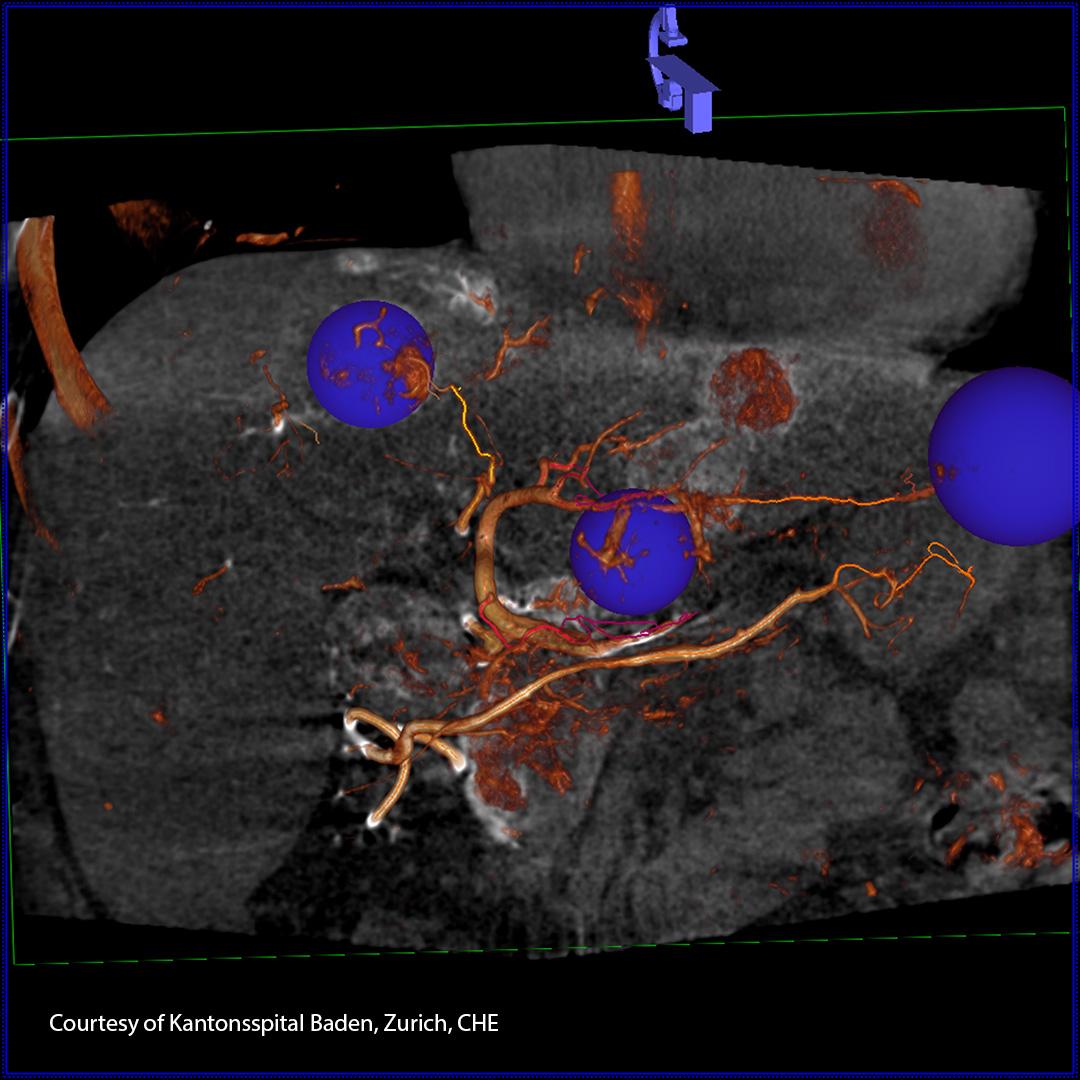 Liver embolization for automatic feeder detection to visualize as many tumor nodules and their feeding vessels 