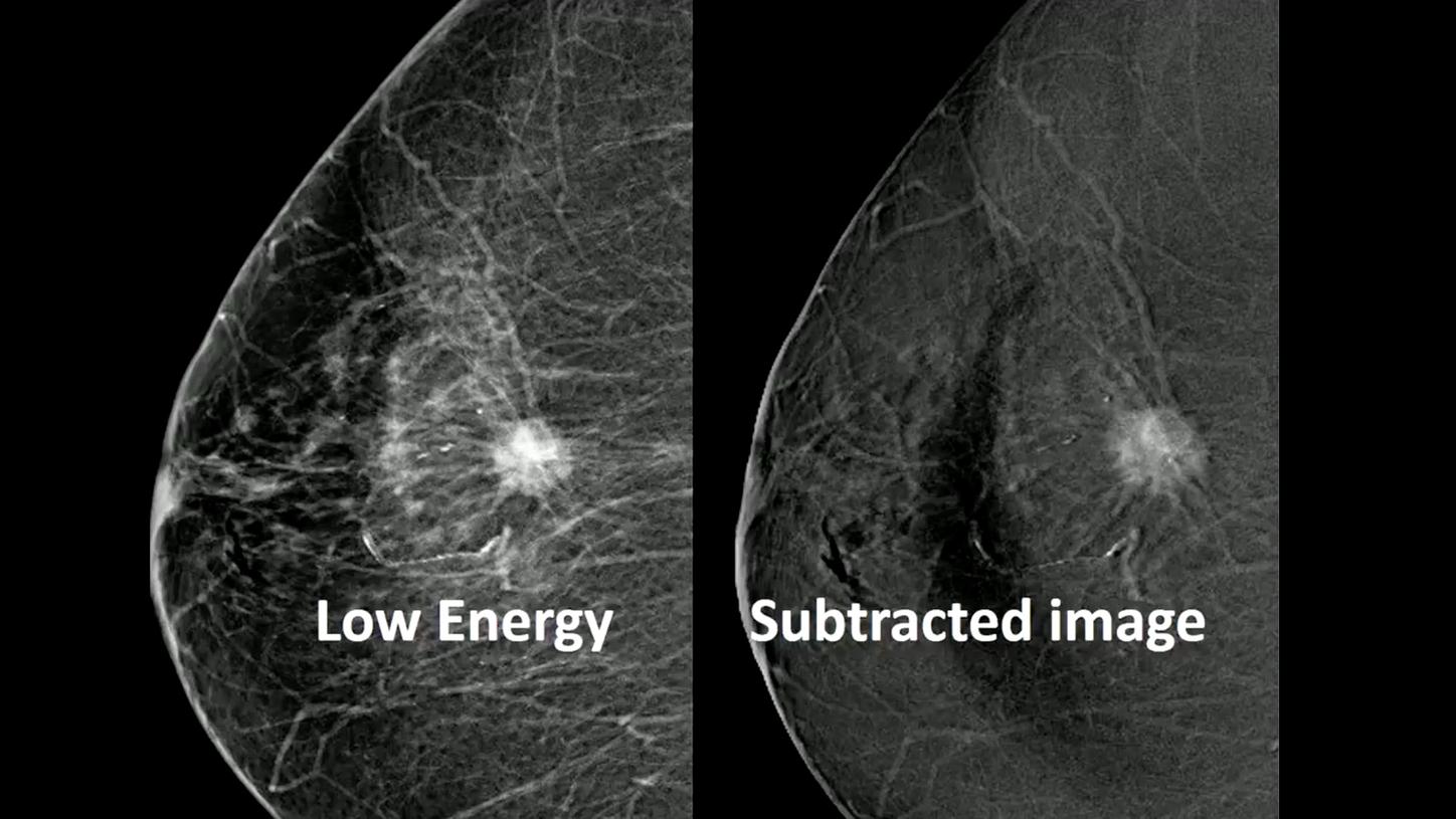 Contrast-enhanced mammography