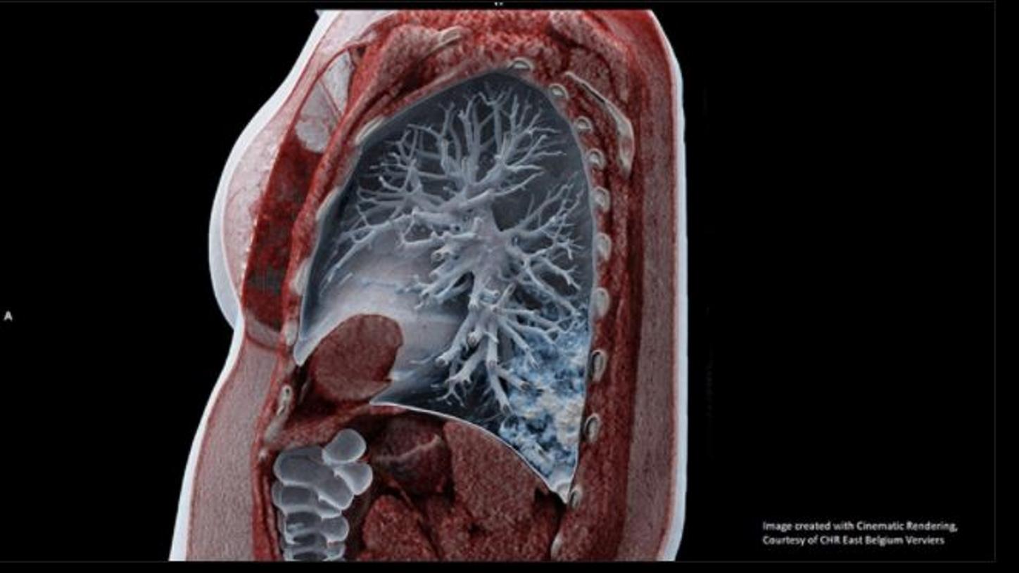 Lung CT