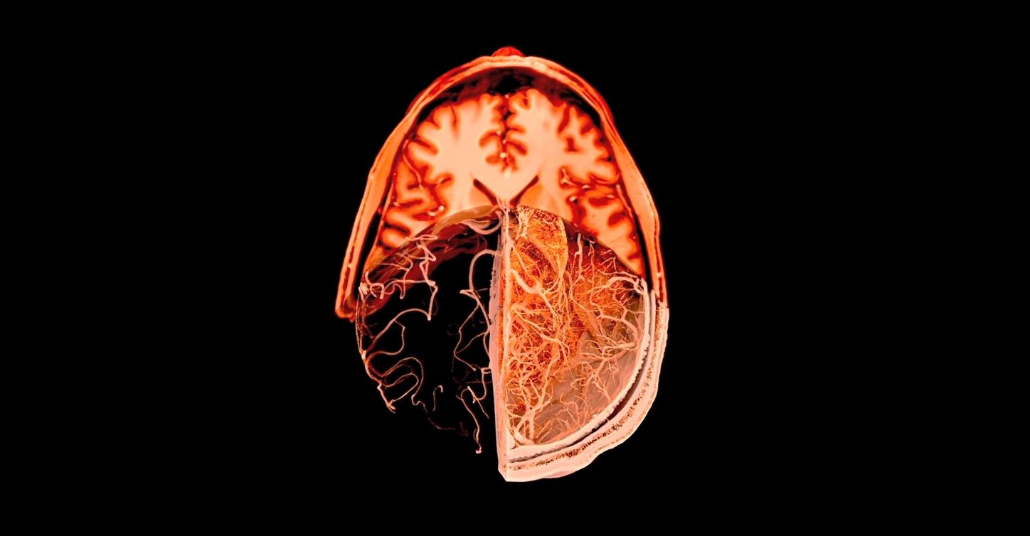 MRI imaging brain