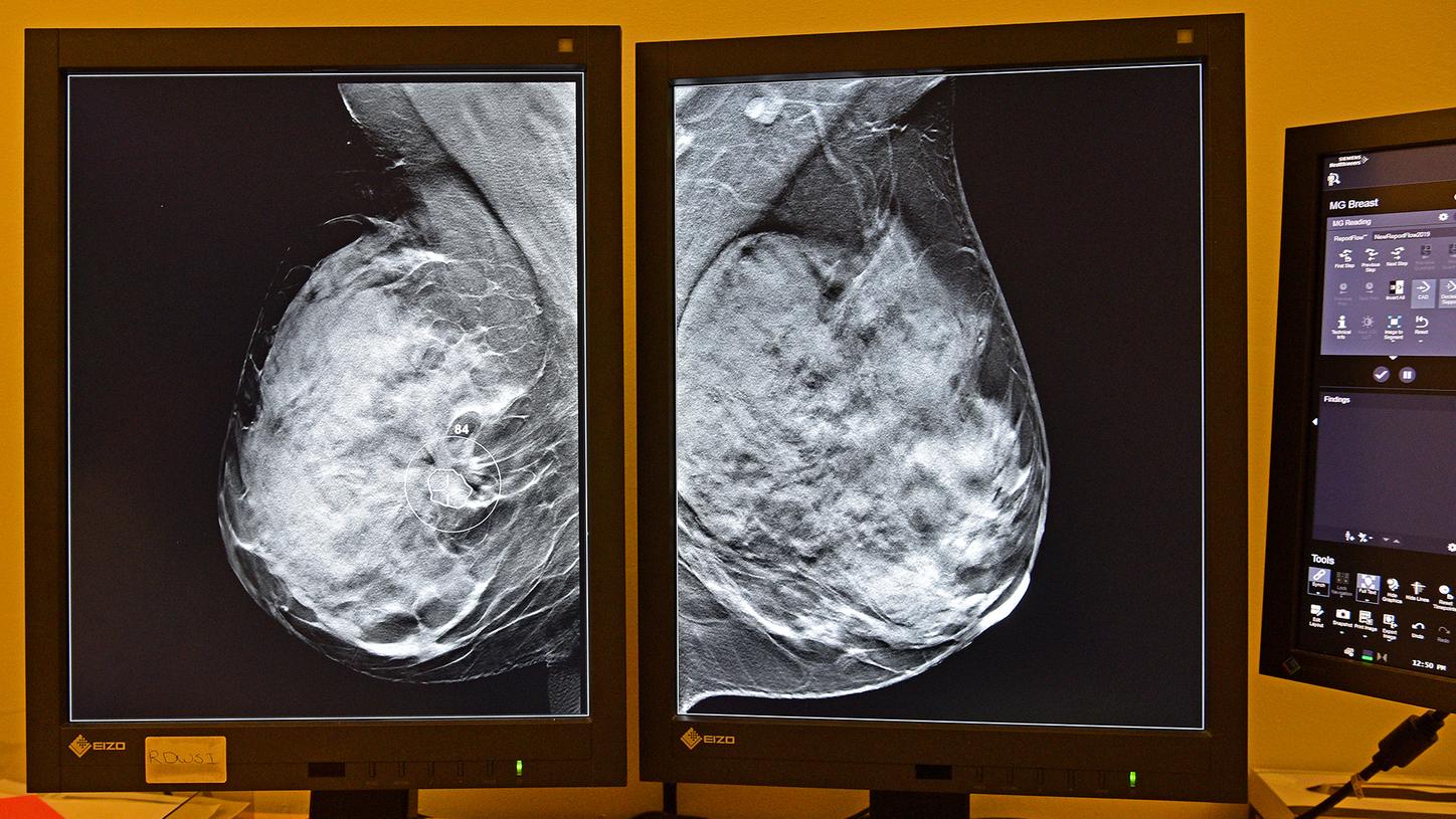 Tomosynthesis evaluation is also facilitated with the AI software.