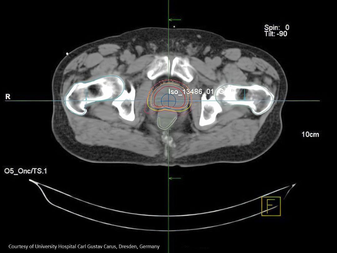 CT scan of prostate 