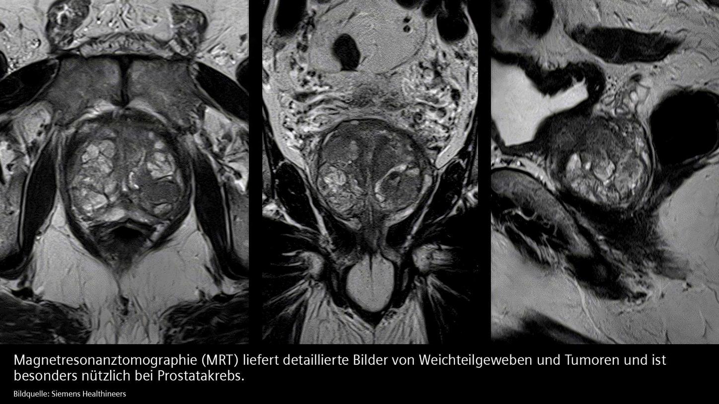 MRT liefert detaillierte Bilder von Weichteilen und Tumoren und ist besonders nützlich bei Prostatakrebs.