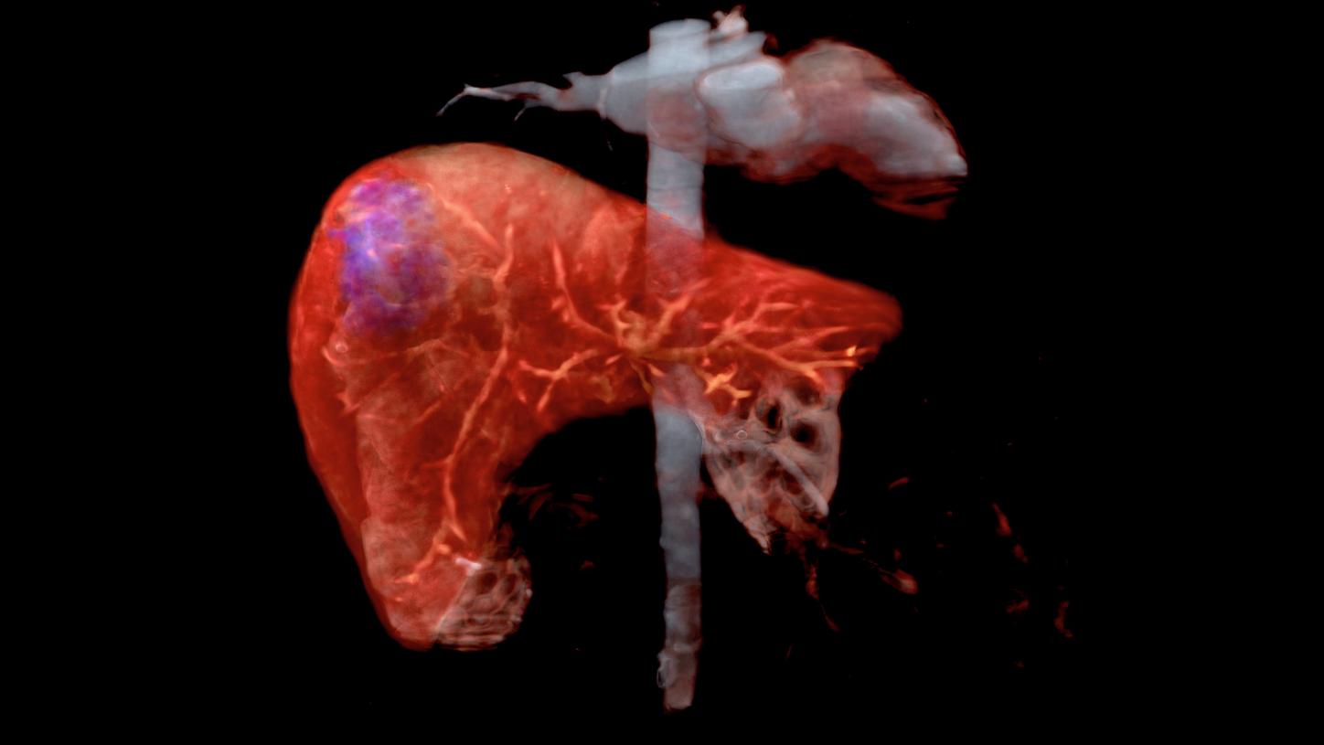 Clinical fields Liver Cancer