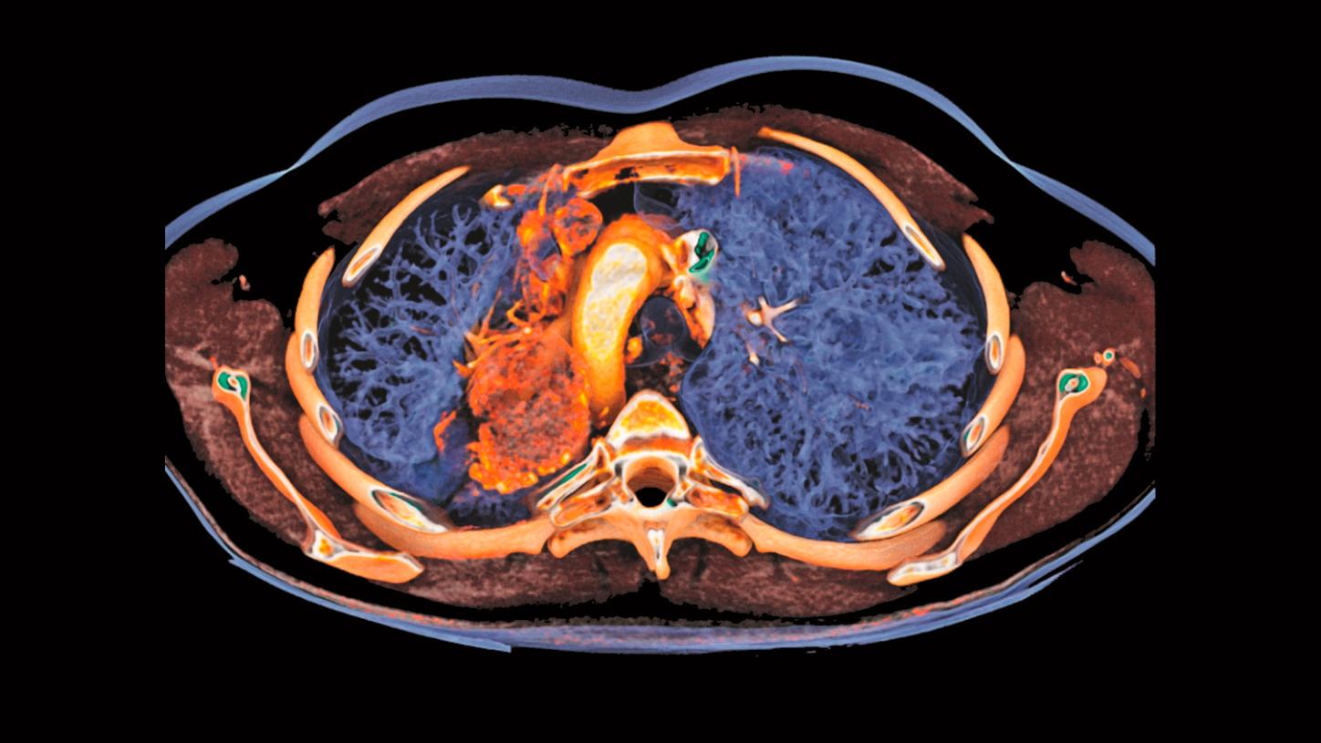 CT imaging in oncology