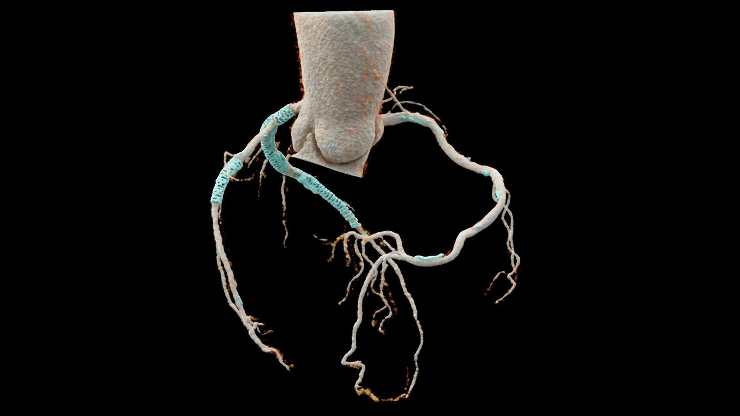 A cinematic VRT image rendered with UHR images shows a three-dimensional view of the coronary tree with the stents and the calcified plaques highlighted in blue.