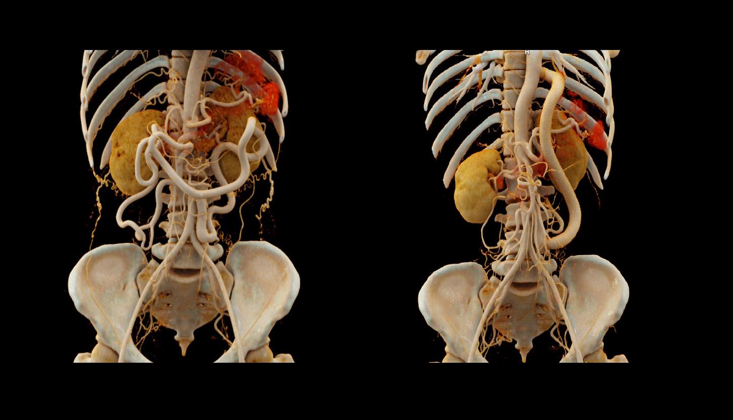 Two cVRT images show an overview of a d-TGA in three dimensions. Bilateral posterior pulmonary hypertension, causing a limited volume of the inflated lungs (in blue), is also seen. The bronchial tree appeared normal.