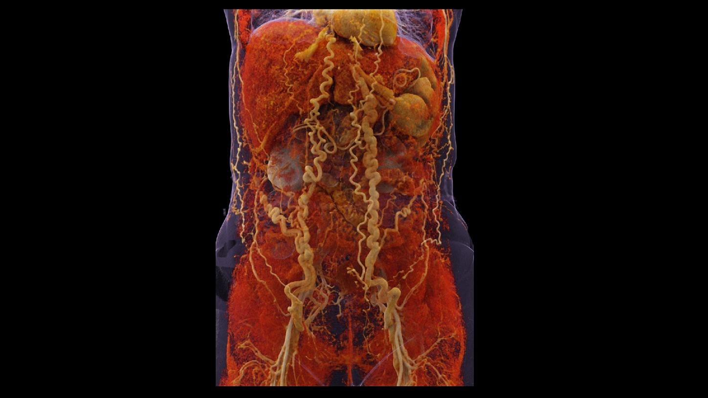 A cVRT image shows a splenomegaly and abdominal wall varices.