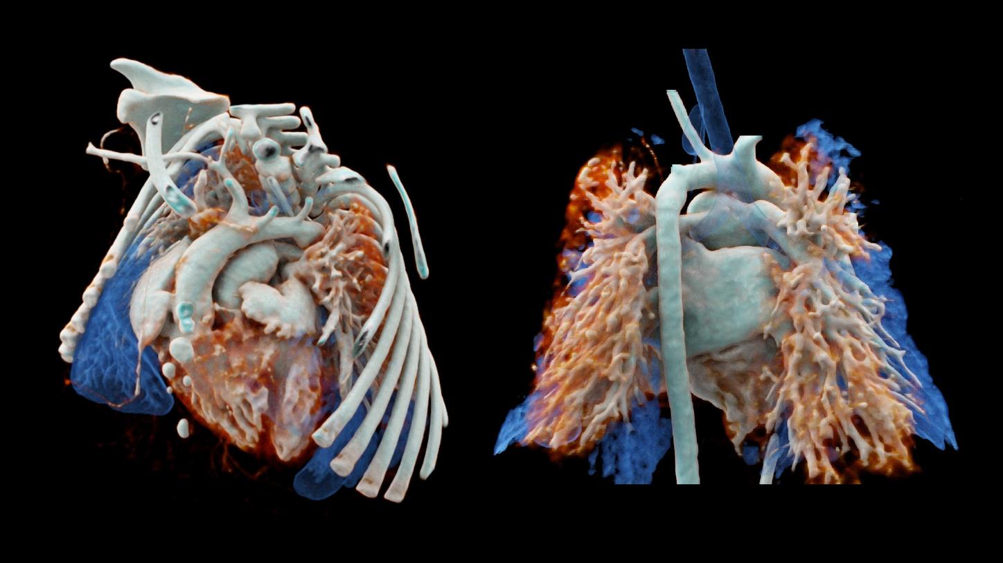 Two cVRT images show an overview of a d-TGA in three dimensions. Bilateral posterior pulmonary hypertension, causing a limited volume of the inflated lungs (in blue), is also seen. The bronchial tree appeared normal.