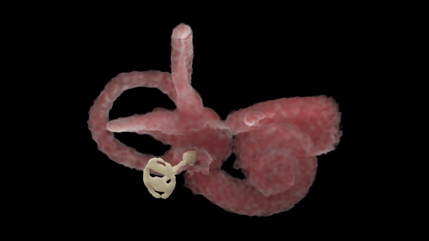 A cVRT image shows a splenomegaly and abdominal wall varices.