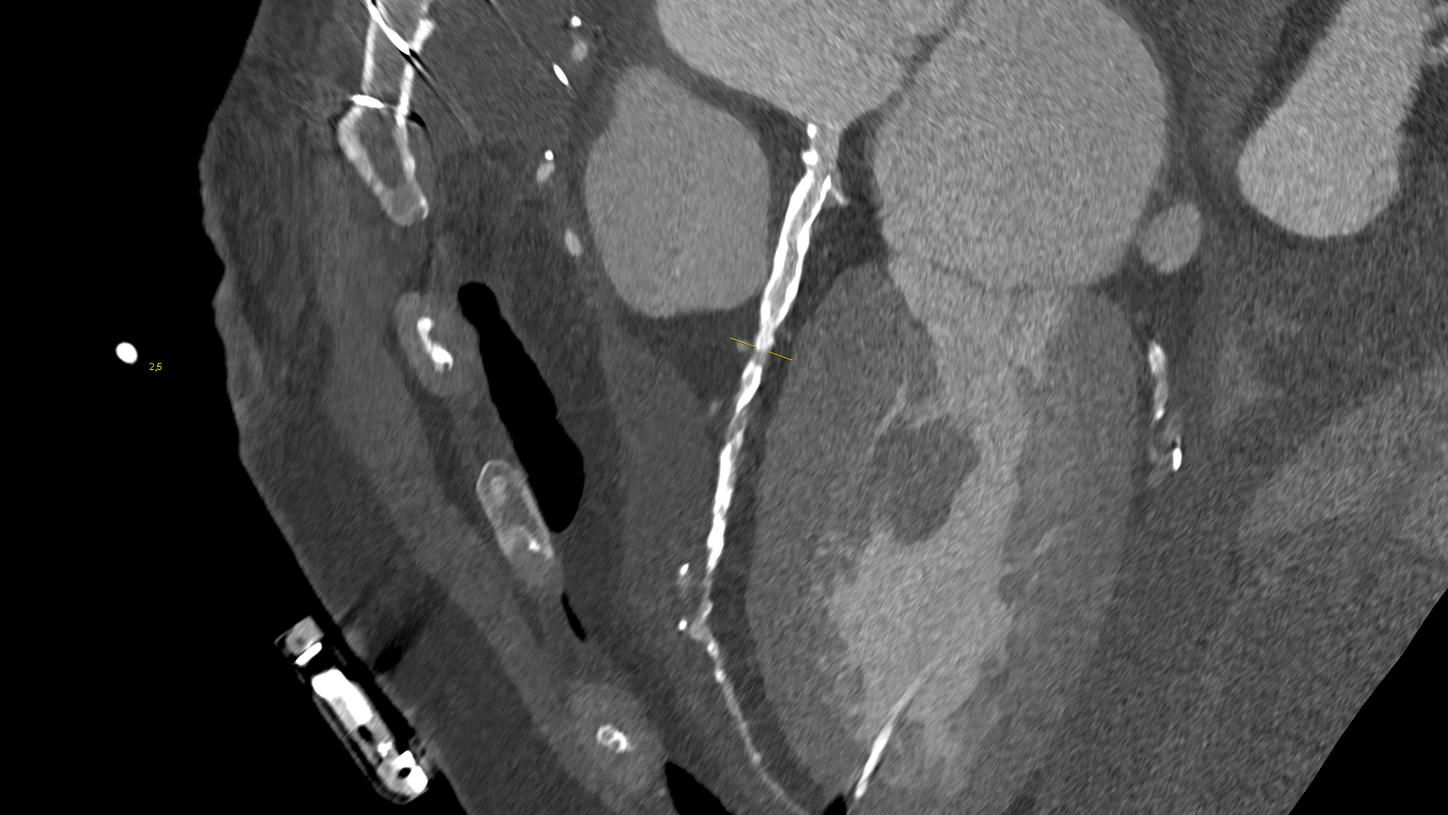 This high-resolution cardiac image shows small details in coronary CTA and is an example of the advanced CT imaging techniques. 