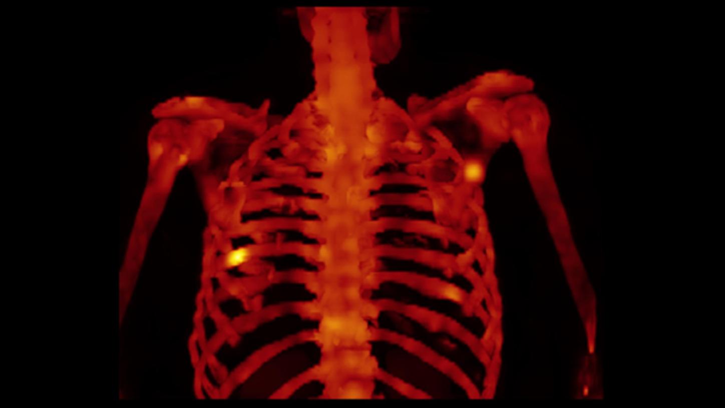xSPECT Bone