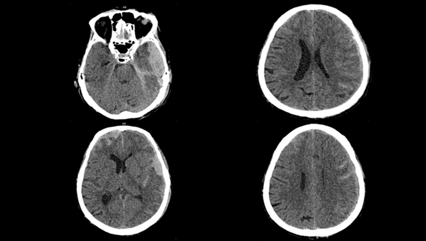 Clinical Image - Mobil Stroke Unit