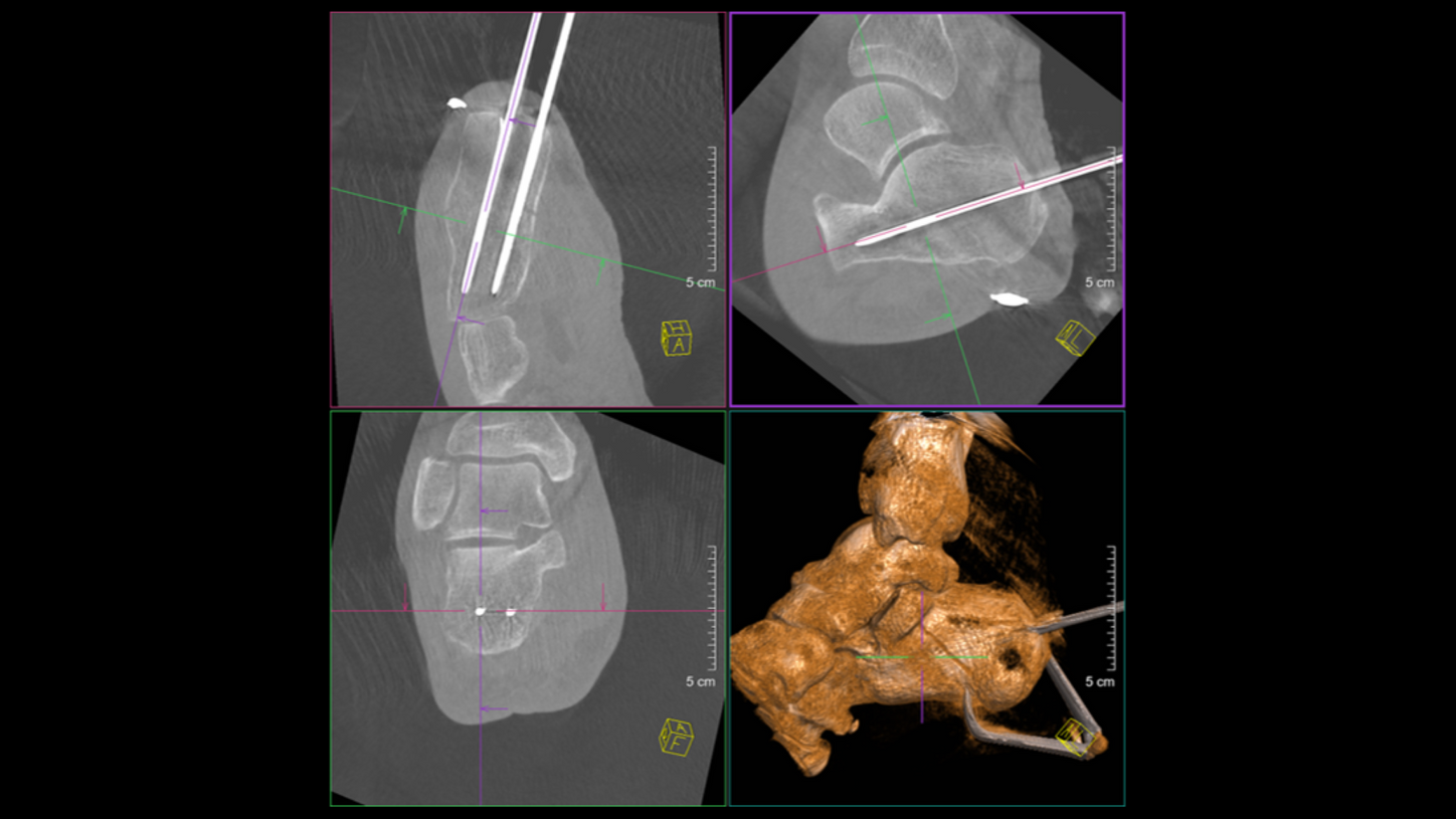 Minimally invasive osteosynthesis of the calcaneus.