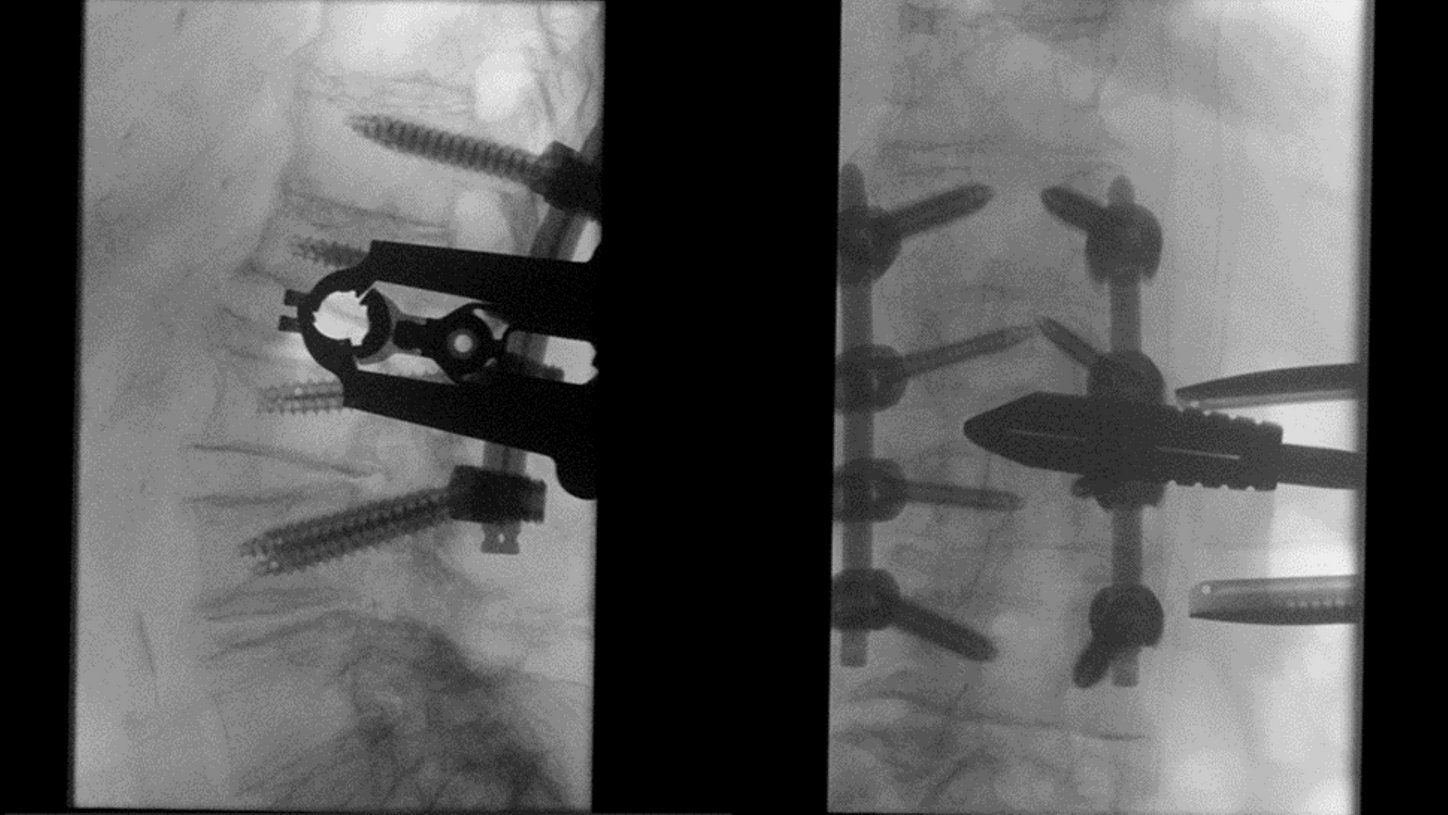 L2/L3 distraction fracture: Minimally invasive lateral interbody fusion. 