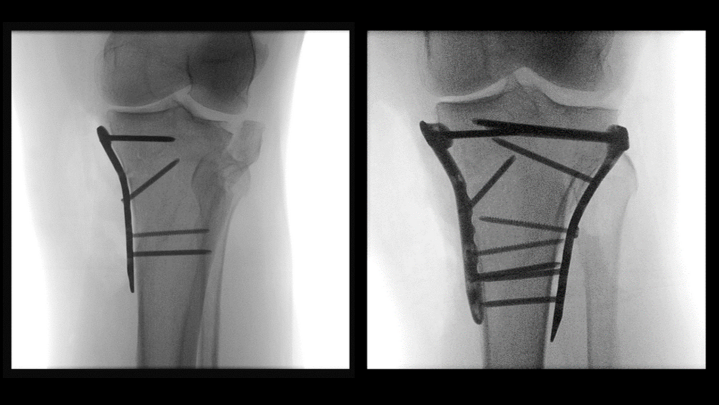 Lateral tibial plateau impression fracture: Open reduction and internal fixation with medial and lateral 3.5-mm proximal tibia plate.