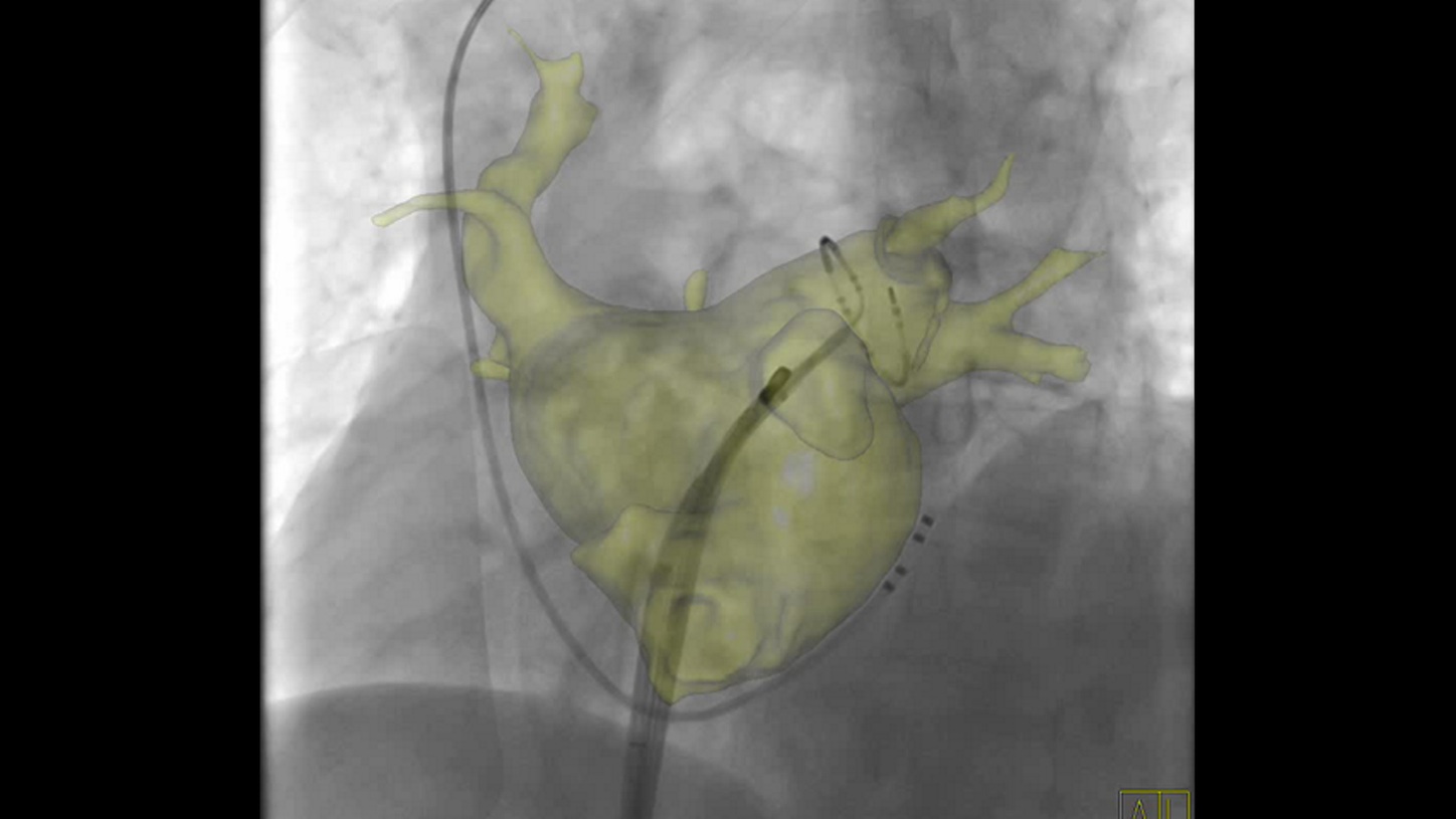 Arrhythmias