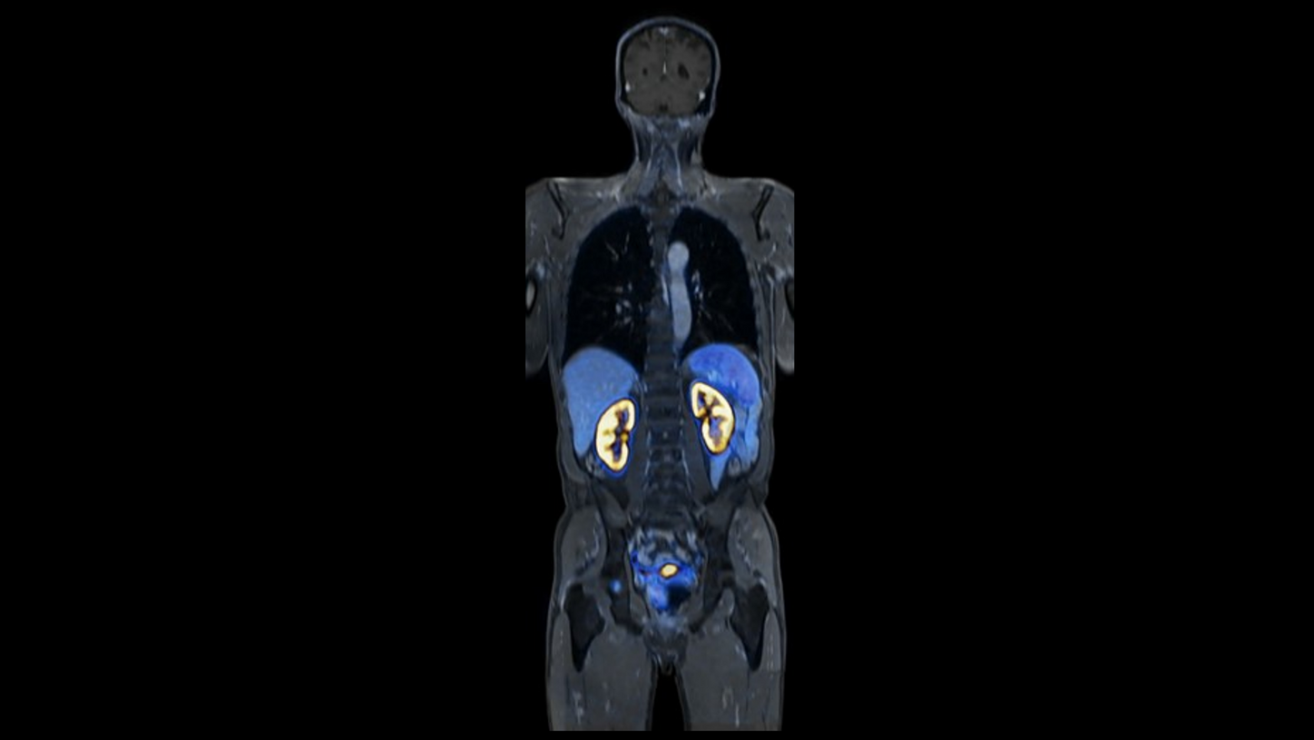 Prostate Cancer – PET/MR imaging  
